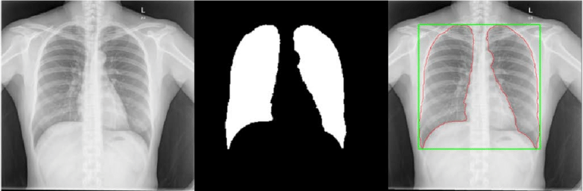 Image masking on an X-ray image